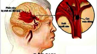 SKLĐ – Tai biến mạch máu não và cách sử lý ban đầu